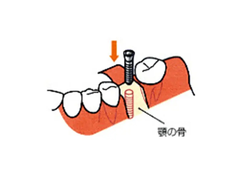 インプラント埋入手術